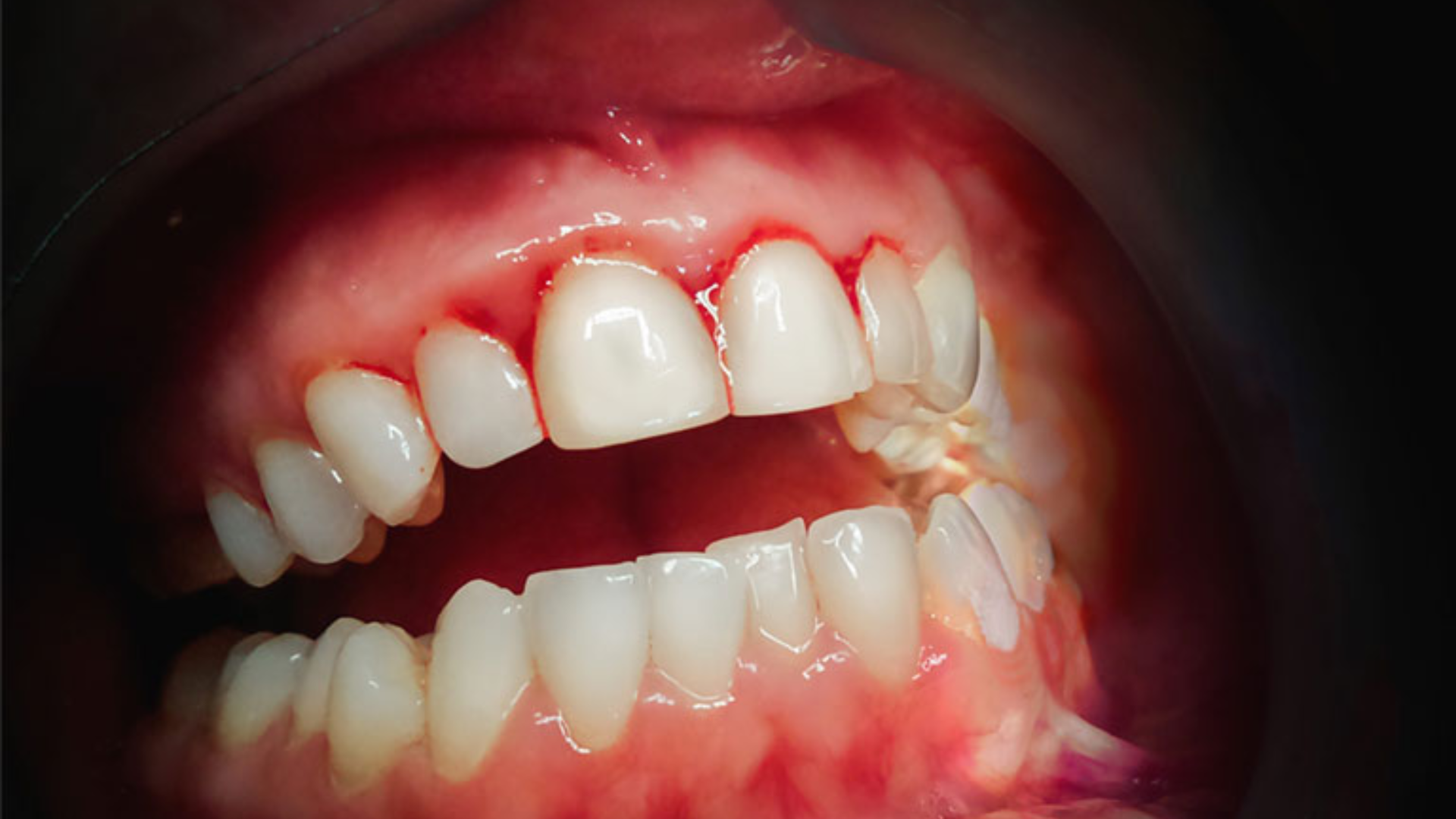 Chảy máu chân răng thường xuyên, nếu không xử lý sớm thì dễ tiến triển thành viêm nha chu nguy hiểm