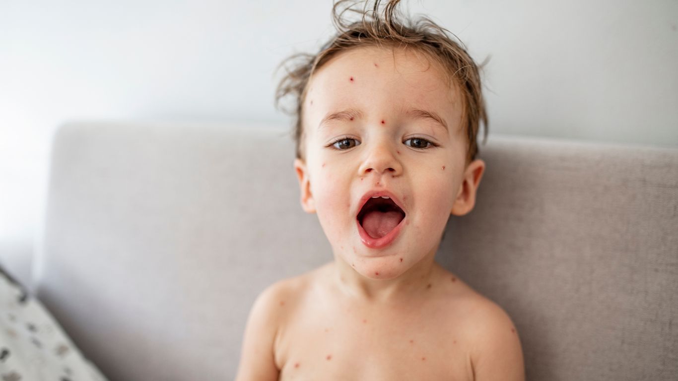 Thủy đậu đóng vảy đã khỏi chưa? Dấu hiệu nhận biết và cách xử lý đúng cách 2