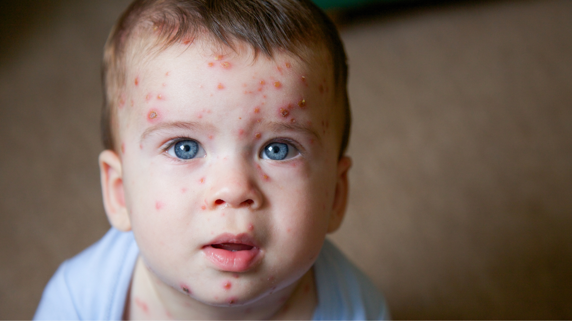 thuy-dau-lay-qua-duong-nao-bien-phap-phong-benh-thuy-dau-hieu-qua (2).png