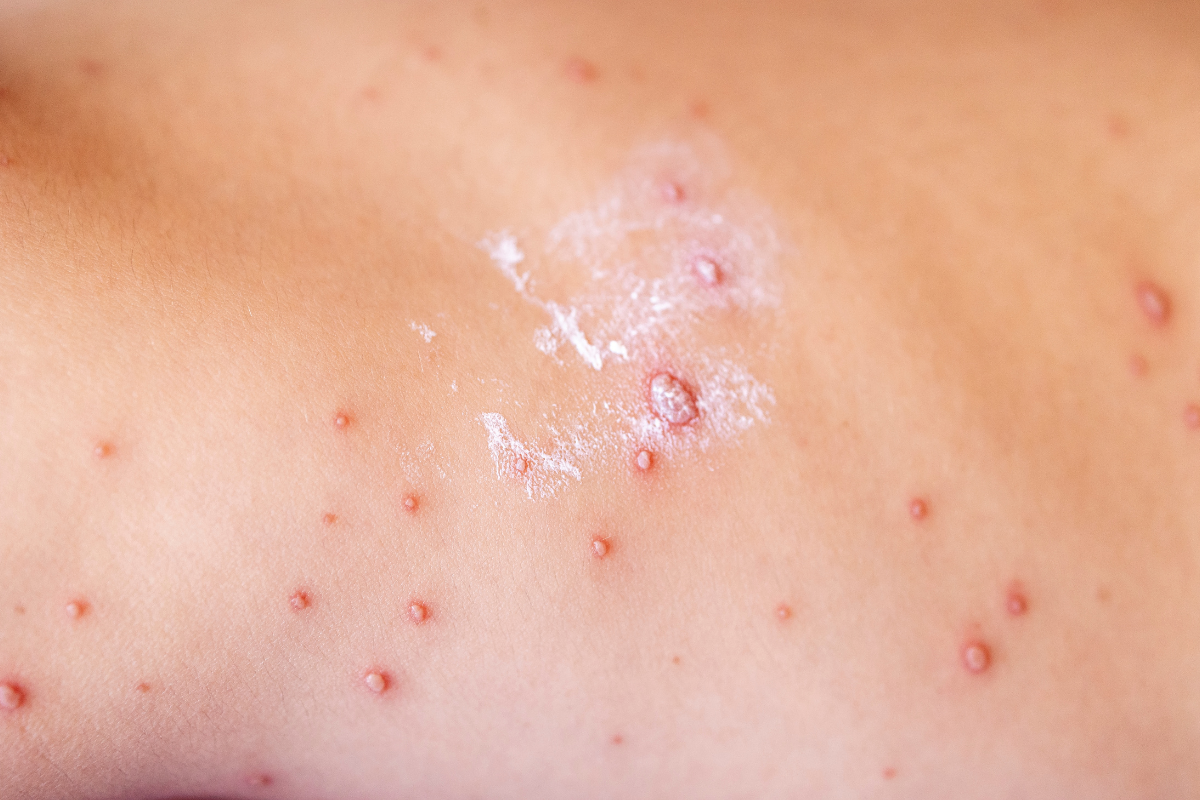 thuy-dau-moc-it-nhan-biet-qua-3-bieu-hien-pho-bien-tren-da 2.png