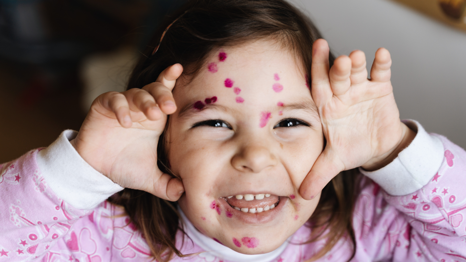 Thủy đậu mọc ở mắt có thể gây biến chứng nếu chăm sóc sai cách