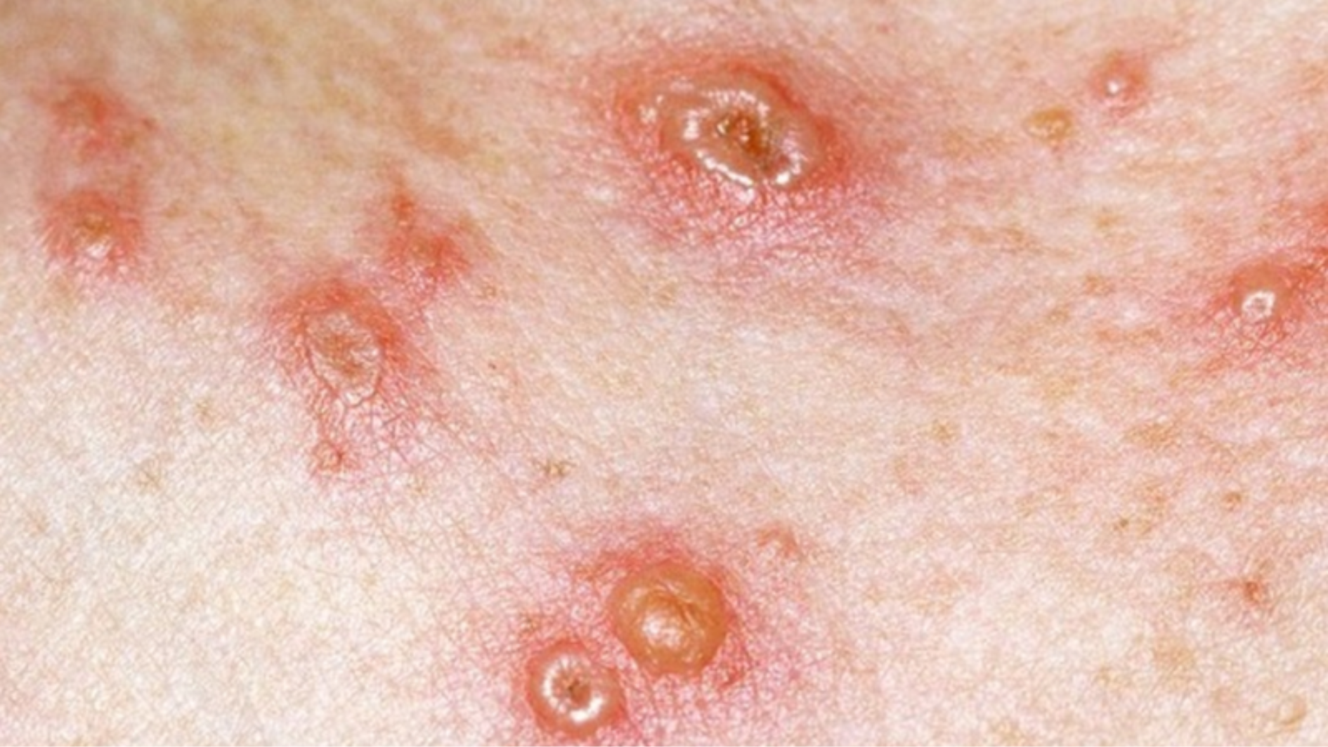 thuy-dau-moc-o-vung-kin-co-dang-lo-ngai-khong-luu-y-khi-bi-thuy-dau (2).png