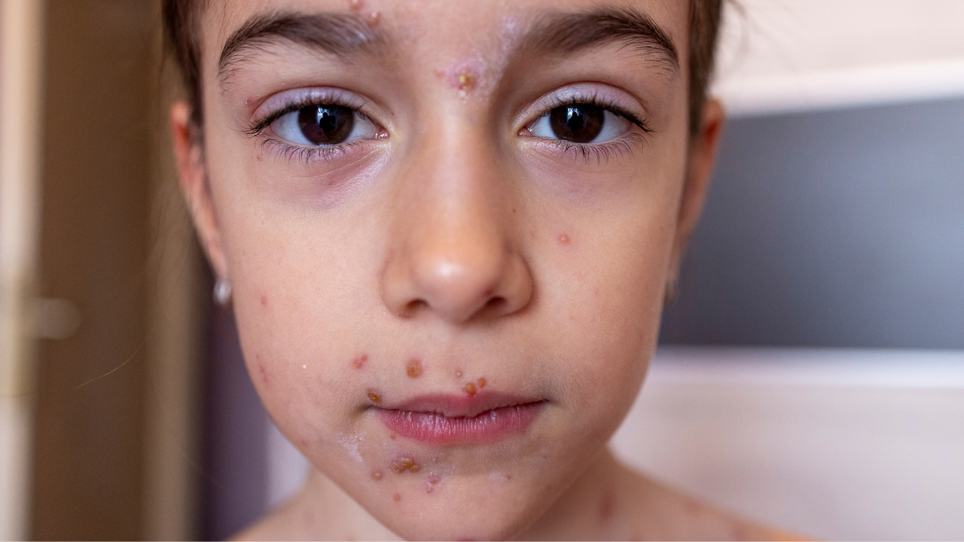 thuy-dau-moc-trong-mieng-co-sao-khong (1).png