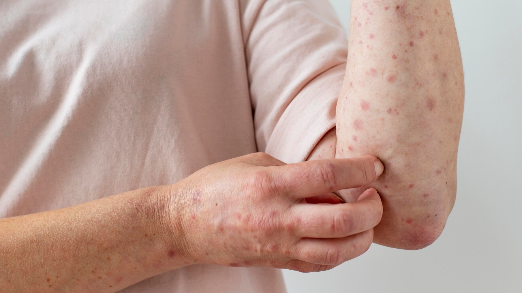 Thủy đậu người lớn là bệnh truyền nhiễm do virus Varicella Zoster gây ra