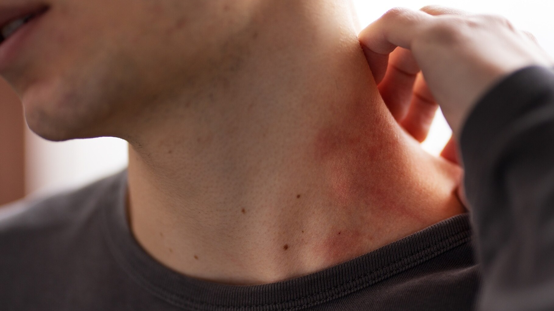 Sau khi sốt, nốt ban đỏ nhỏ bắt đầu xuất hiện