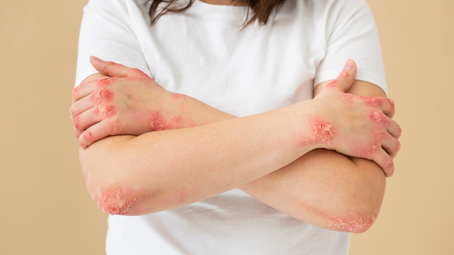 Các mụn nước thủy đậu dễ bị vỡ do gãi hoặc vệ sinh không đúng cách