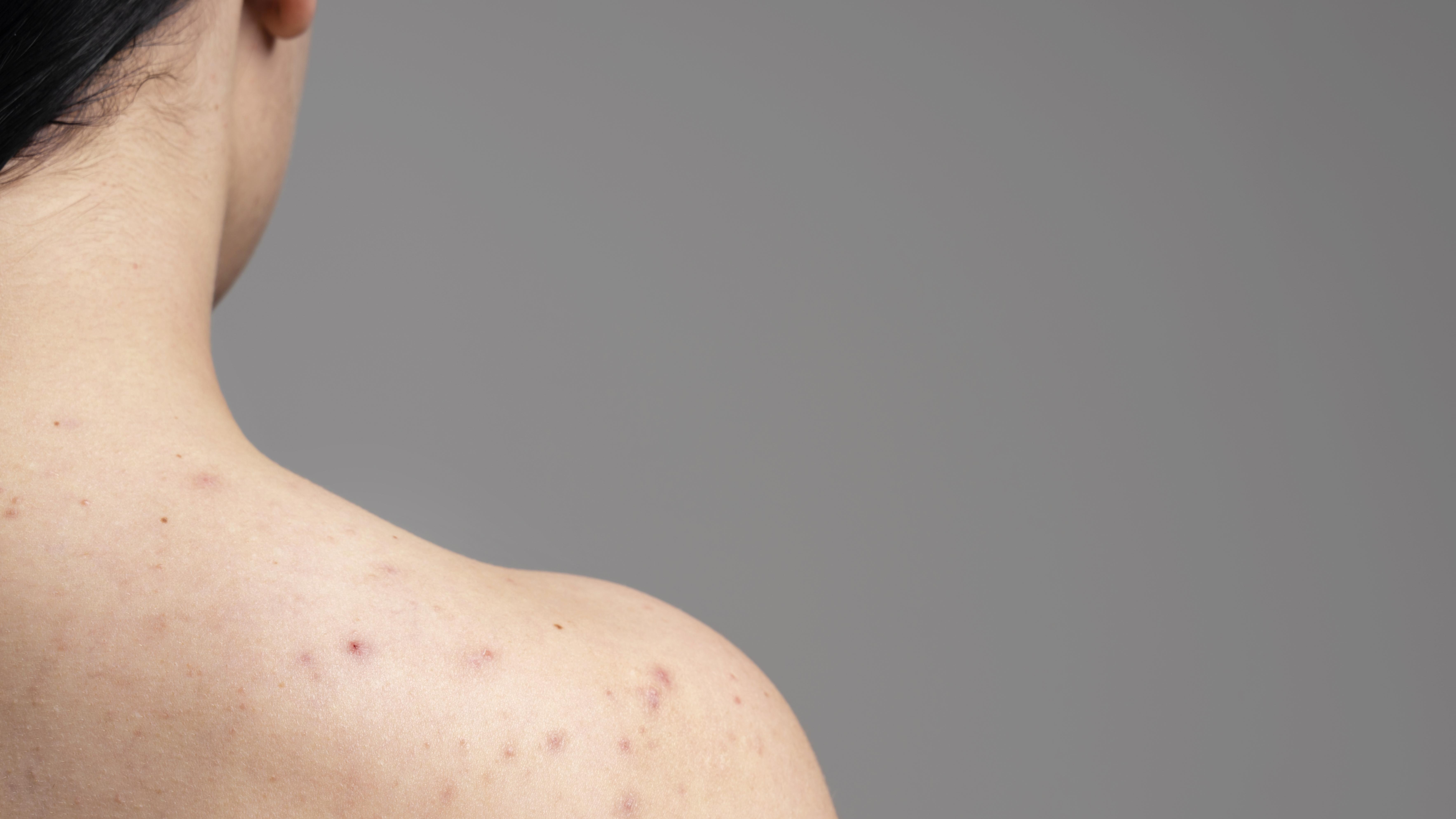 Người thủy đậu uống nước dừa giúp hỗ trợ phục hồi da