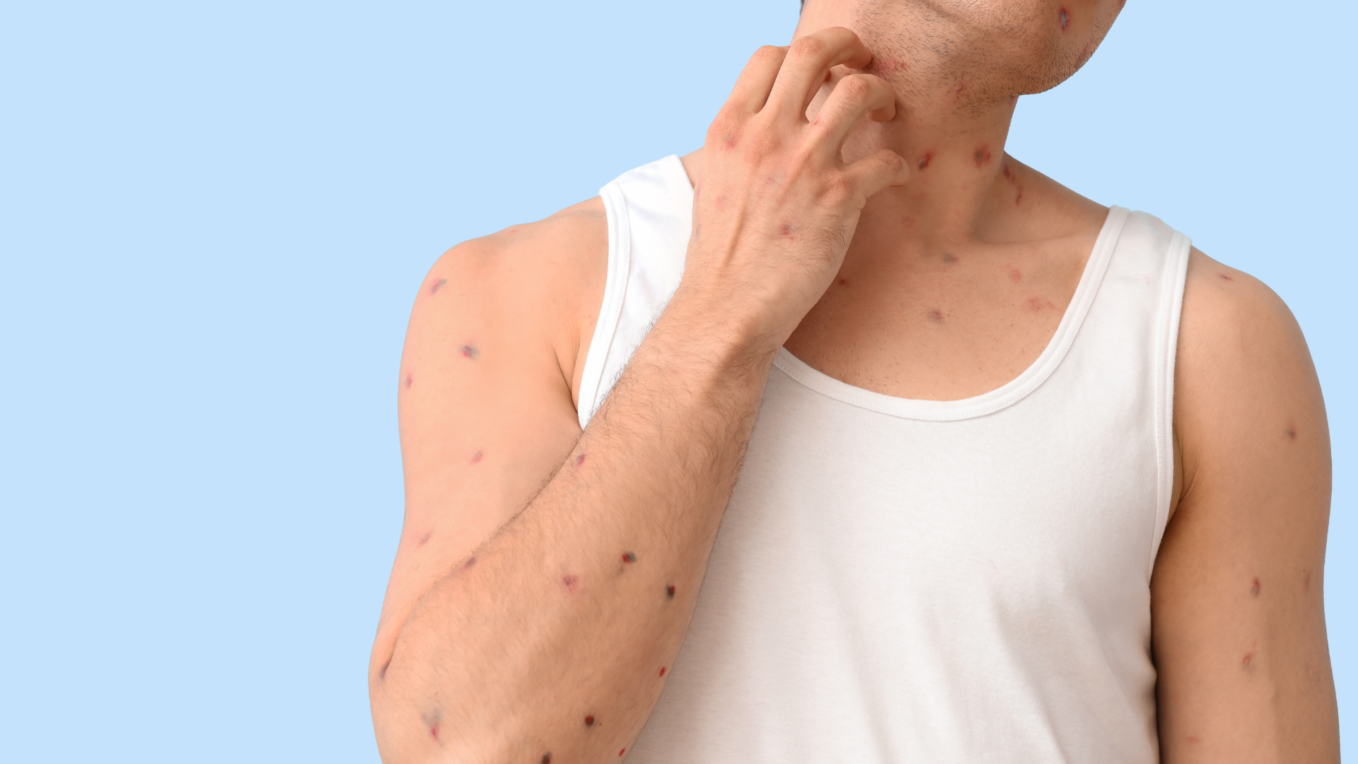 Thủy đậu vào mùa thường tăng mạnh khi thời tiết giao mùa