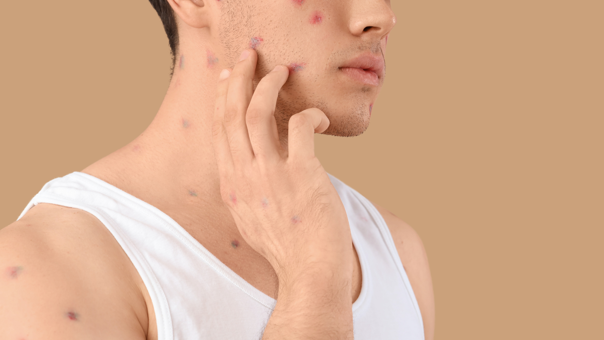 Phát hiện sớm giúp hạn chế lây lan thủy đậu trong gia đình