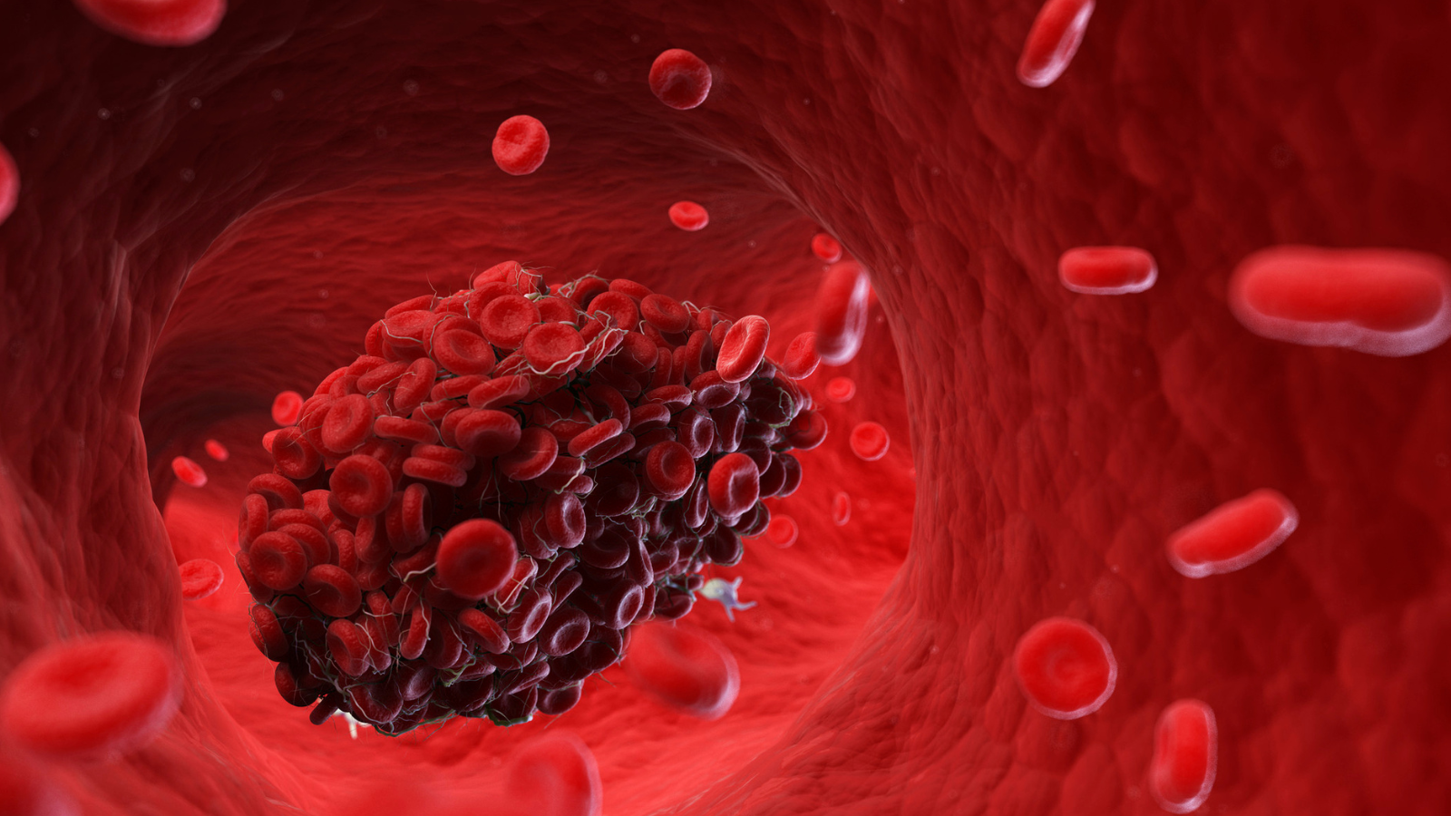 Cục máu đông di chuyển đến phổi