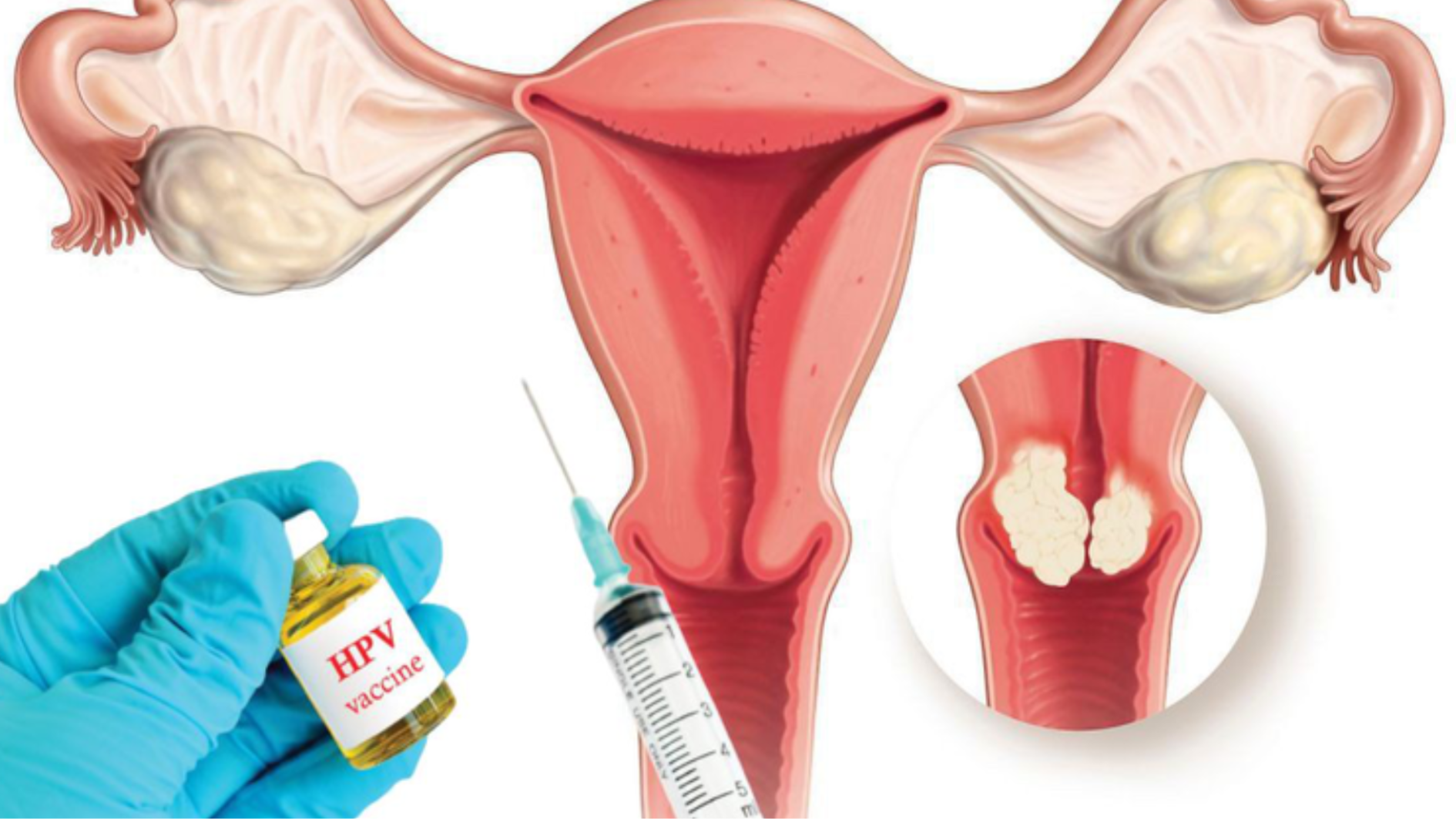 tiem-hpv-co-tac-dung-gi-tiem-hpv-o-dau-an-toan-uy-tin (1).png