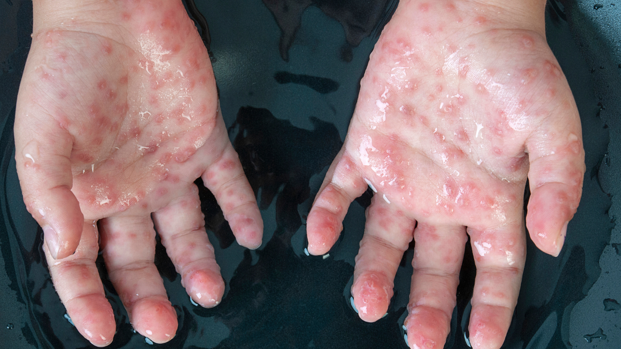 tiem-phong-thuy-dau-roi-co-bi-lay-khong (2).png