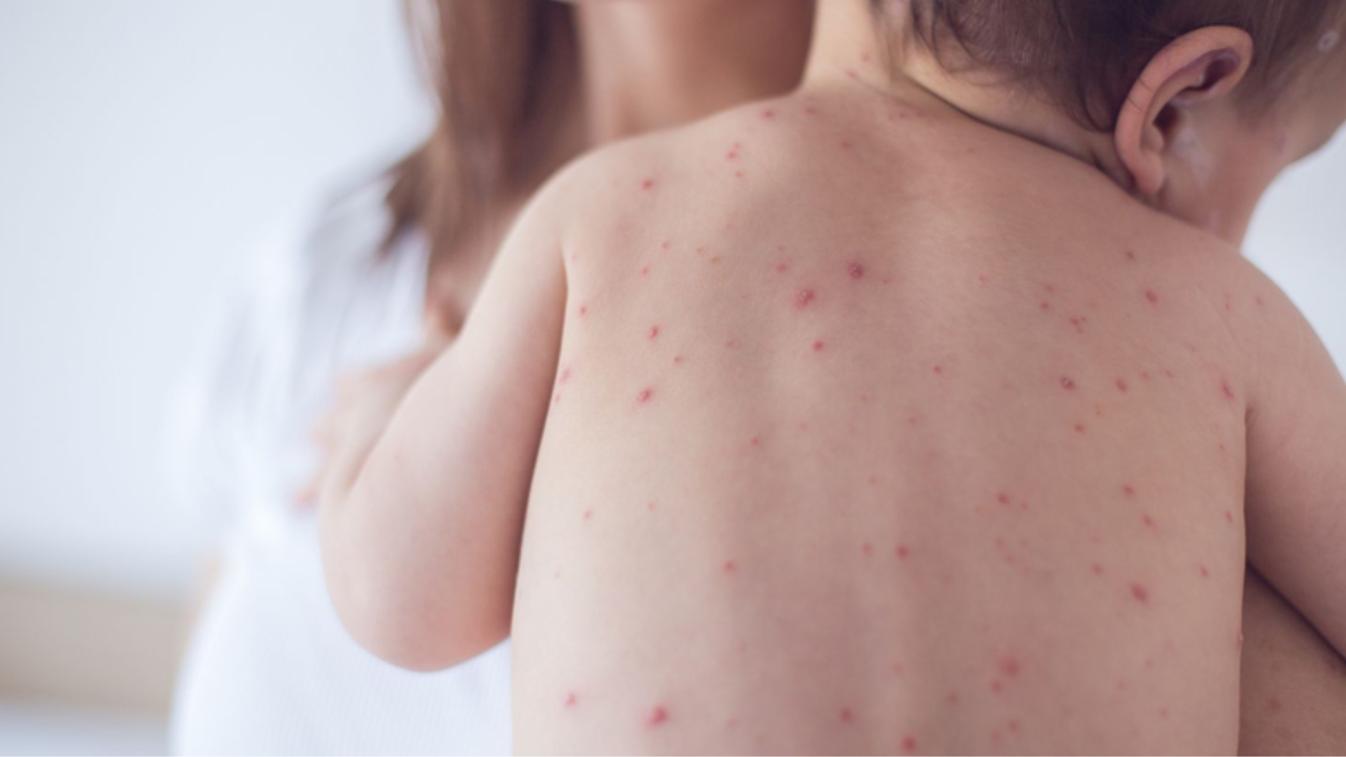 tiem-soi-quai-bi-rubella-cho-be-lich-tiem-va-cham-soc-sau-chung-ngua (1).png