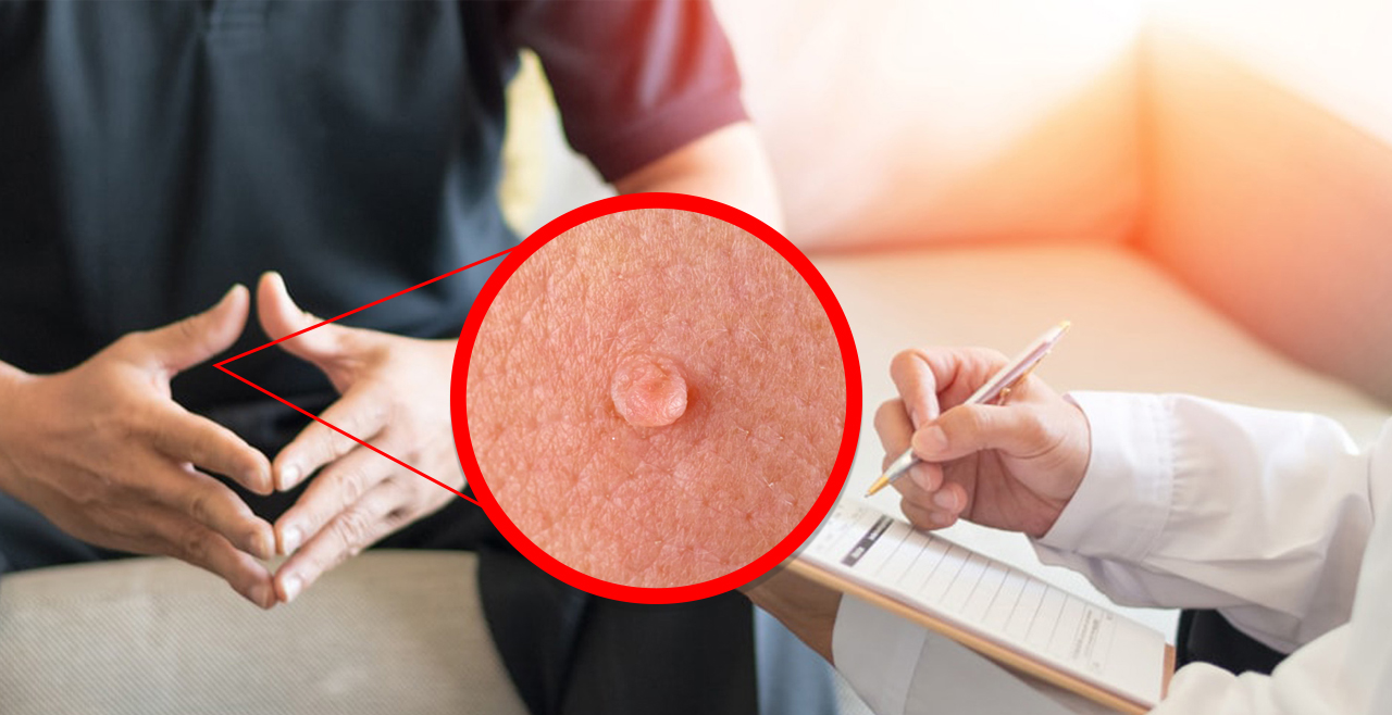 Mụn cóc sinh dục là một dạng bệnh lây truyền qua đường tình dục phổ biến