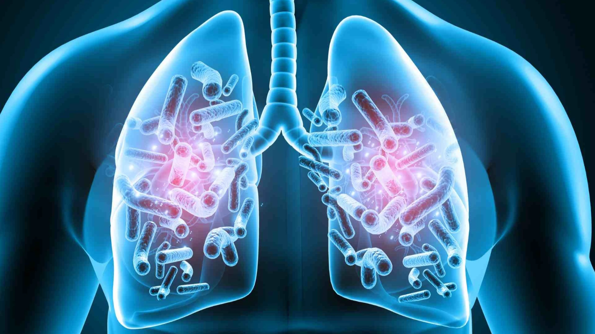 Tiêm vắc xin Phế cầu sớm giúp bảo vệ sức khỏe hô hấp, ngăn ngừa viêm phổi và suy hô hấp