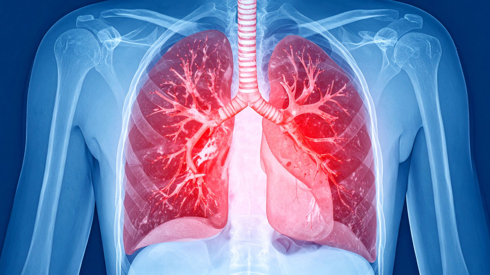 Giảm thiểu tối đa nguy cơ bệnh chuyển biến nặng và ngăn ngừa các biến chứng tim phổi nguy hiểm