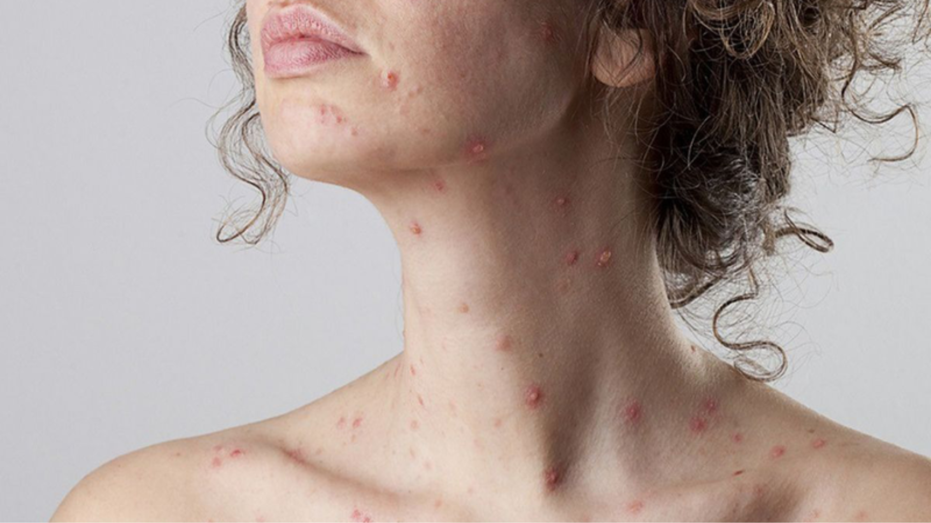 tiem-vac-xin-rubella-bao-lau-thi-co-thai-duoc-nhiem-rubella-khi-mang-thai-phai-lam-sao (3).png