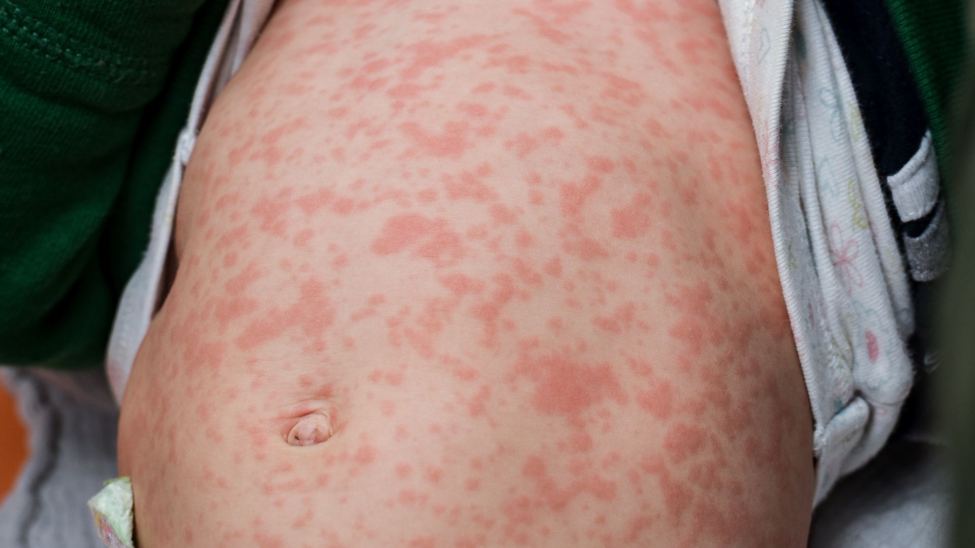 tiem-vac-xin-soi-cho-be-9-thang-tuoi-co-can-thiet-khong 1.jpg