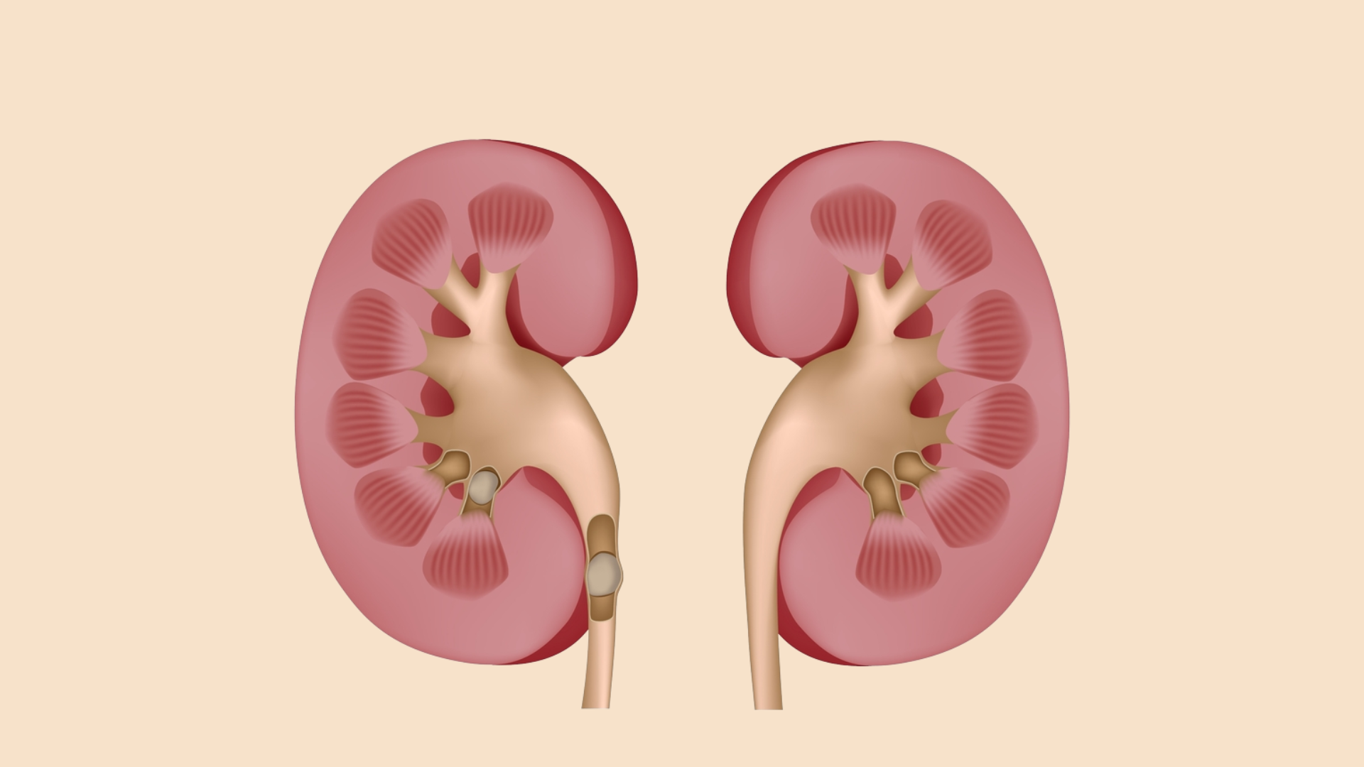 Sỏi thận là một trong những nguyên nhân thường gặp gây tiểu ra máu