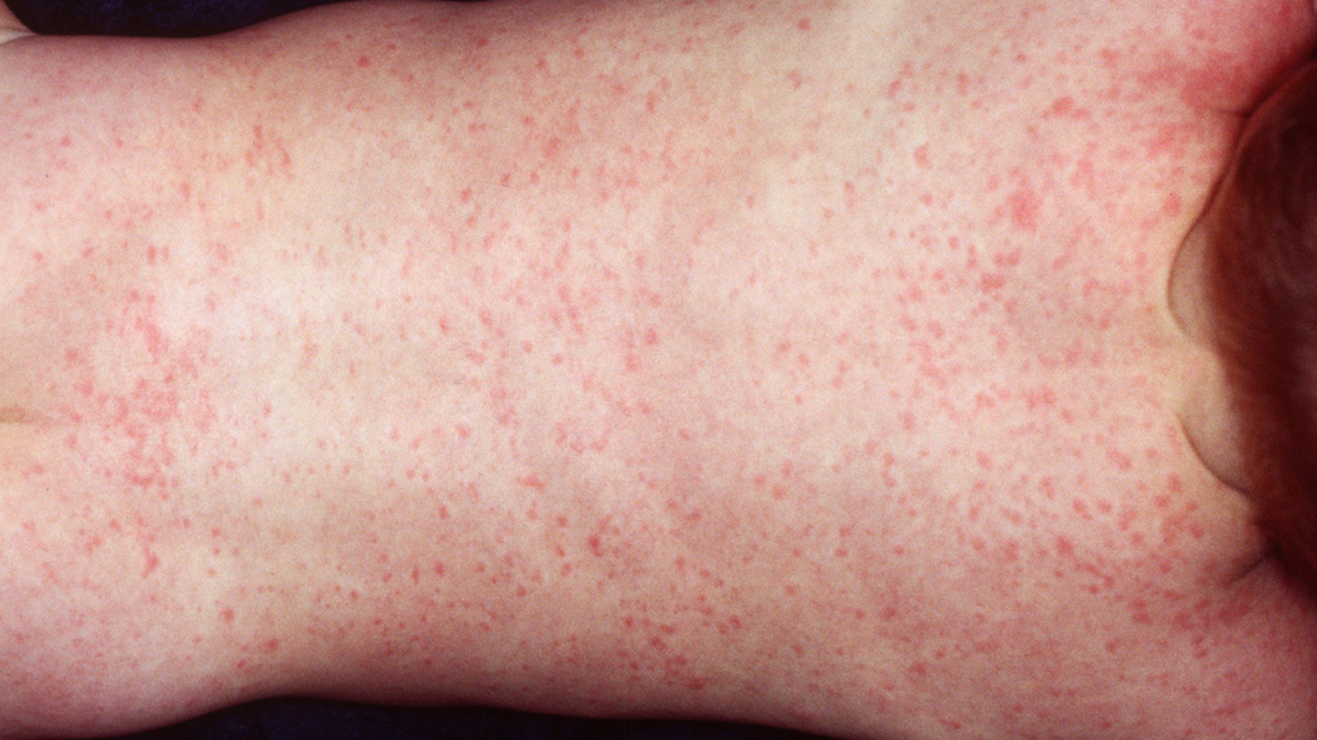 Bệnh ban đào là một bệnh sốt phát ban lành tính