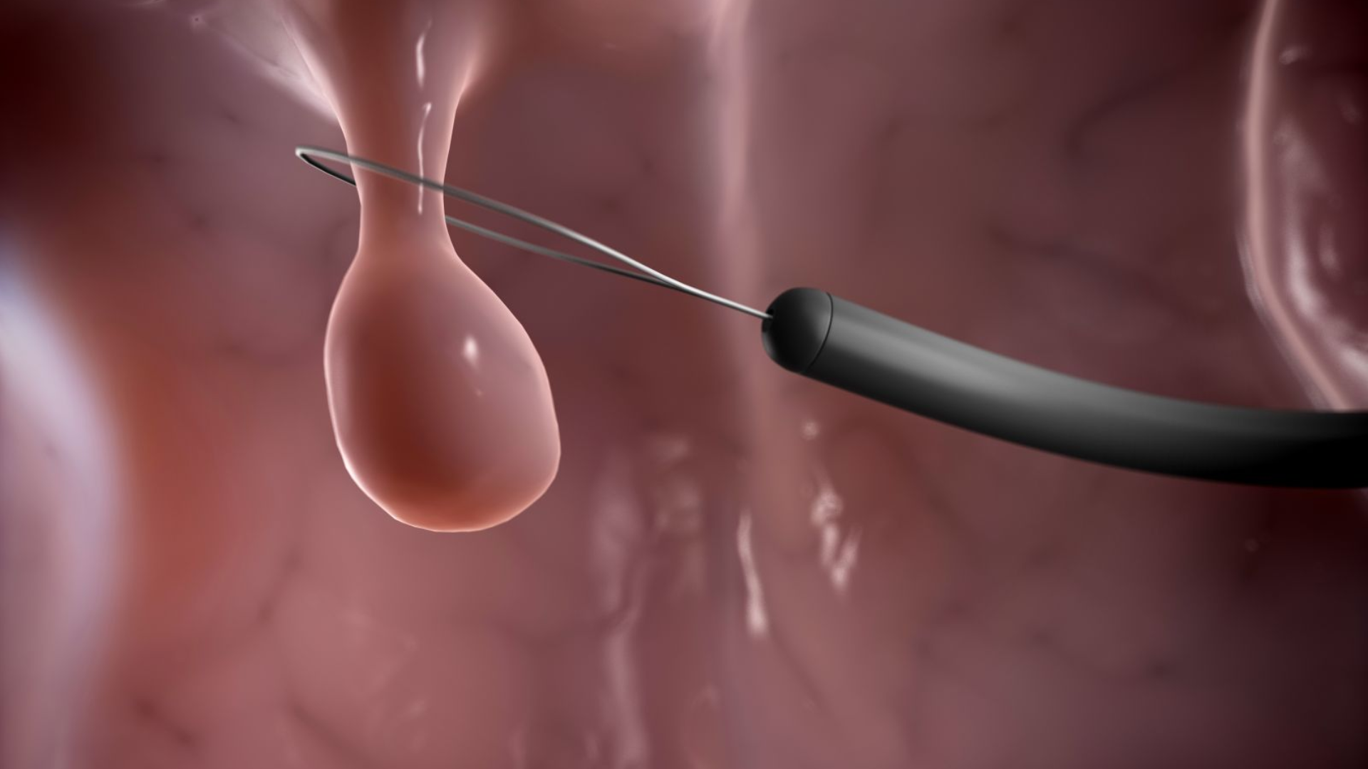 Tìm hiểu nội soi cắt polyp đại tràng và những lưu ý quan trọng cho người bệnh 1