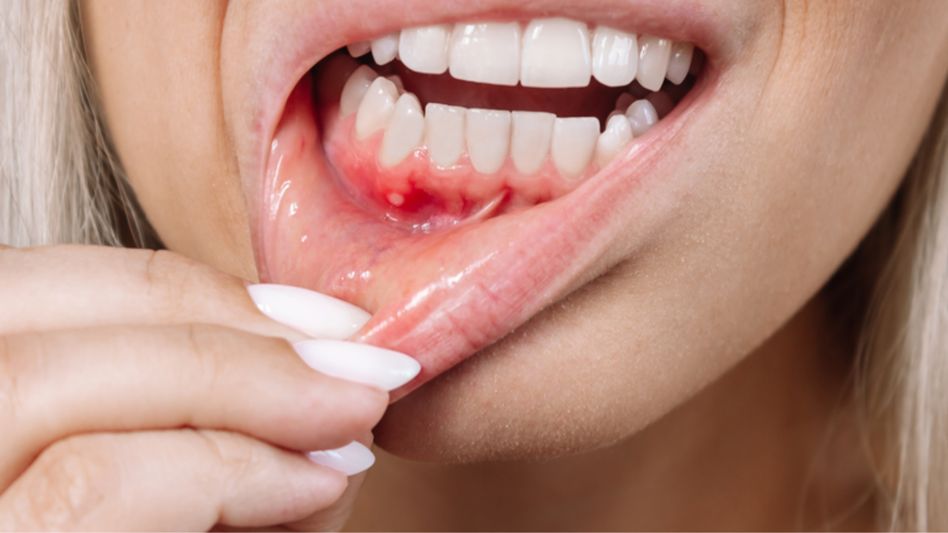 tim-hieu-sot-xuat-huyet-chay-mau-chan-rang-co-nguy-hiem-khong-dieu-tri-nhu-the-nao (2).png