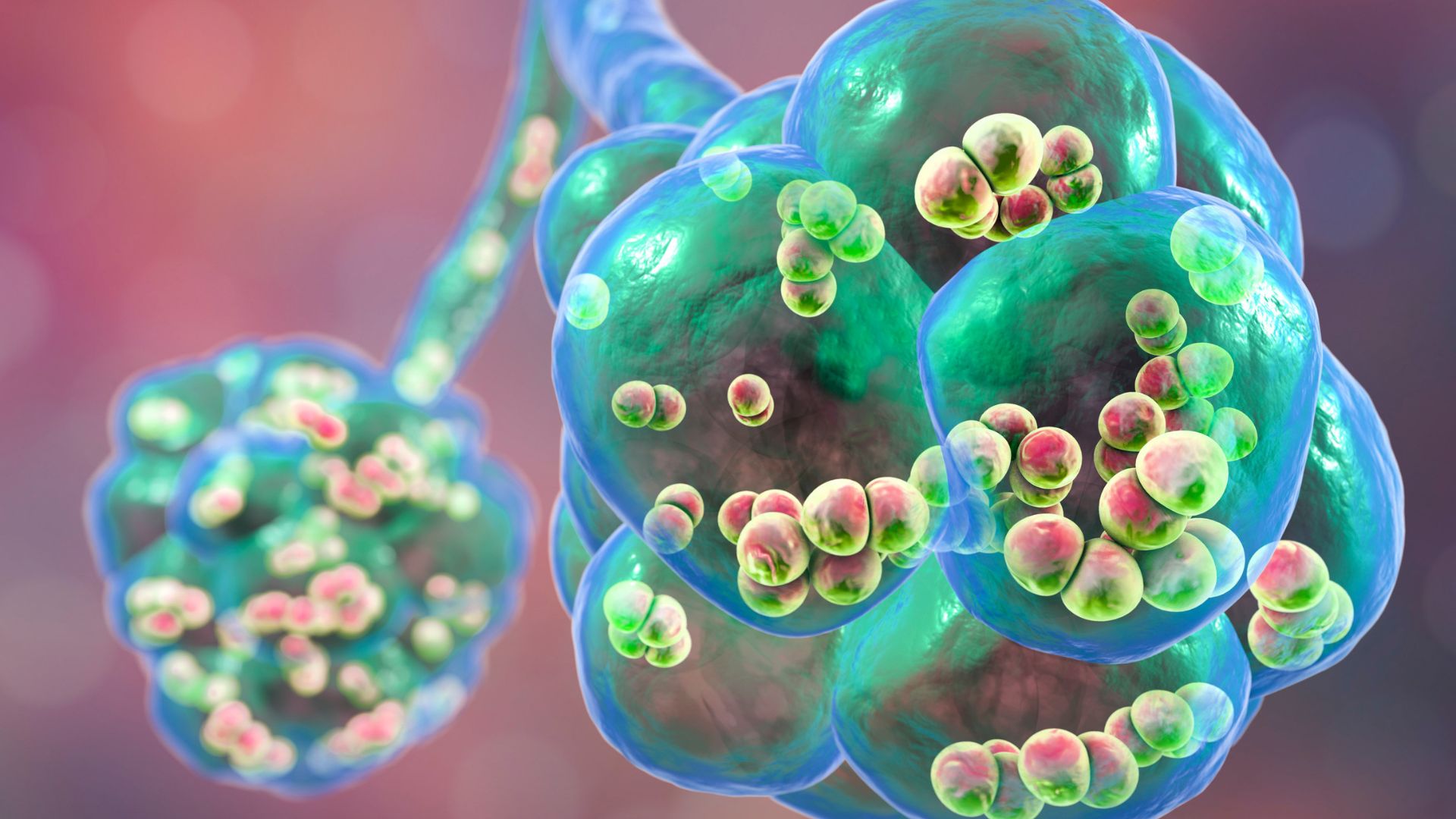 Viêm phổi là 1 trong 4 bệnh gây di chứng nặng do phế cầu khuẩn ở trẻ nhỏ