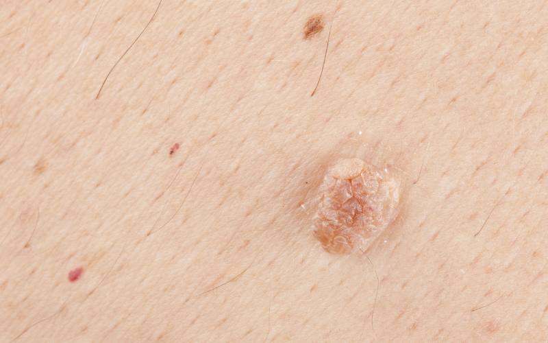 tim-hieu-ve-benh-sui-mao-ga-o-nam-4