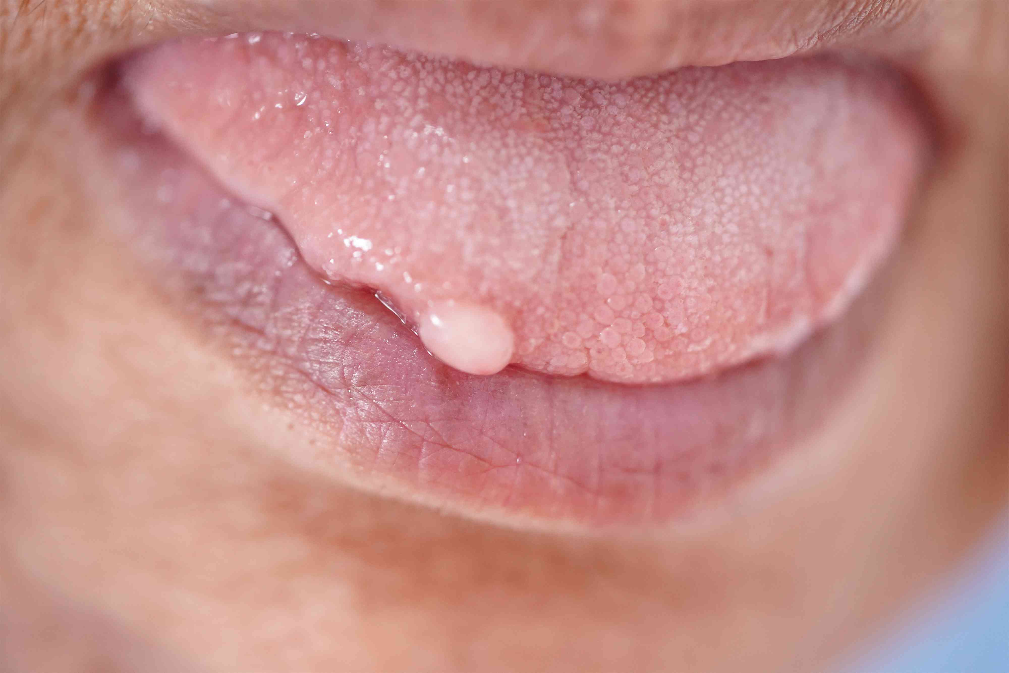 tim-hieu-ve-sui-mao-ga-o-luoi-2