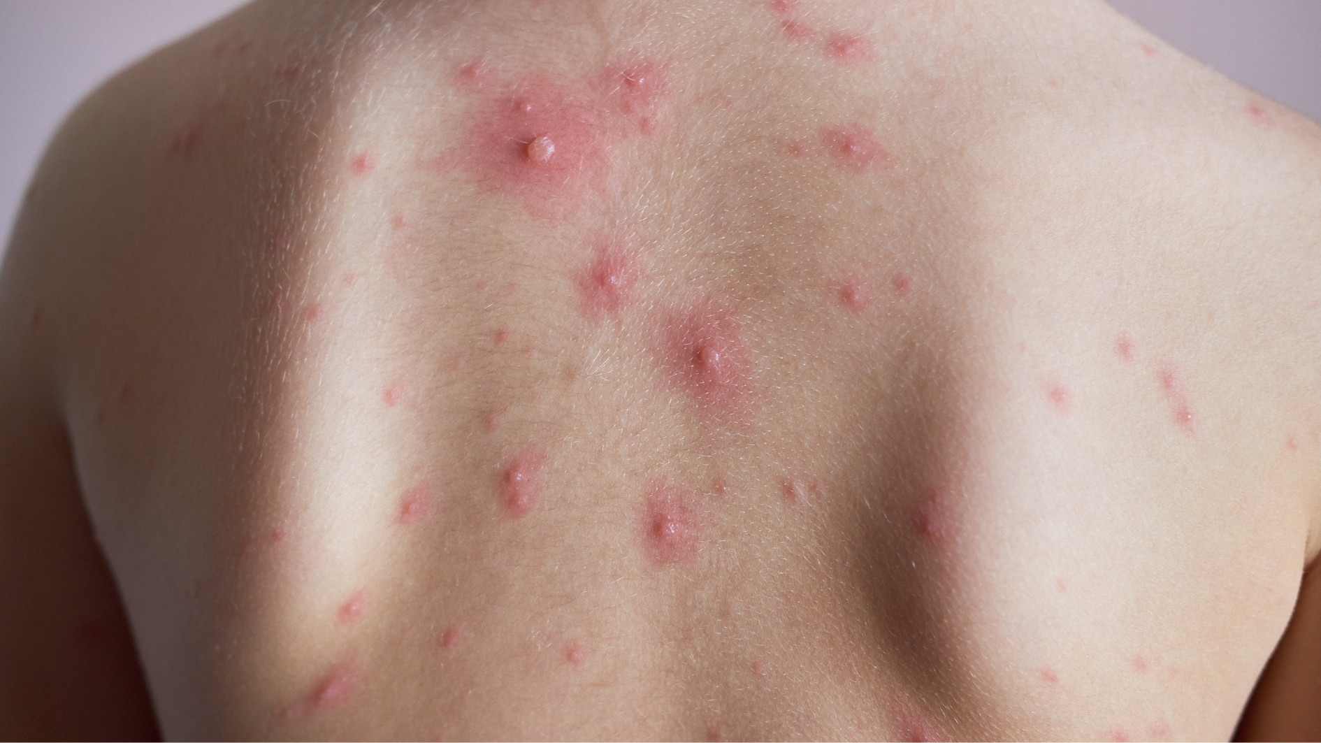 tim-hieu-xet-nghiem-khang-the-la-gi-co-nhung-loai-xet-nghiem-khang-the-nao (4).png