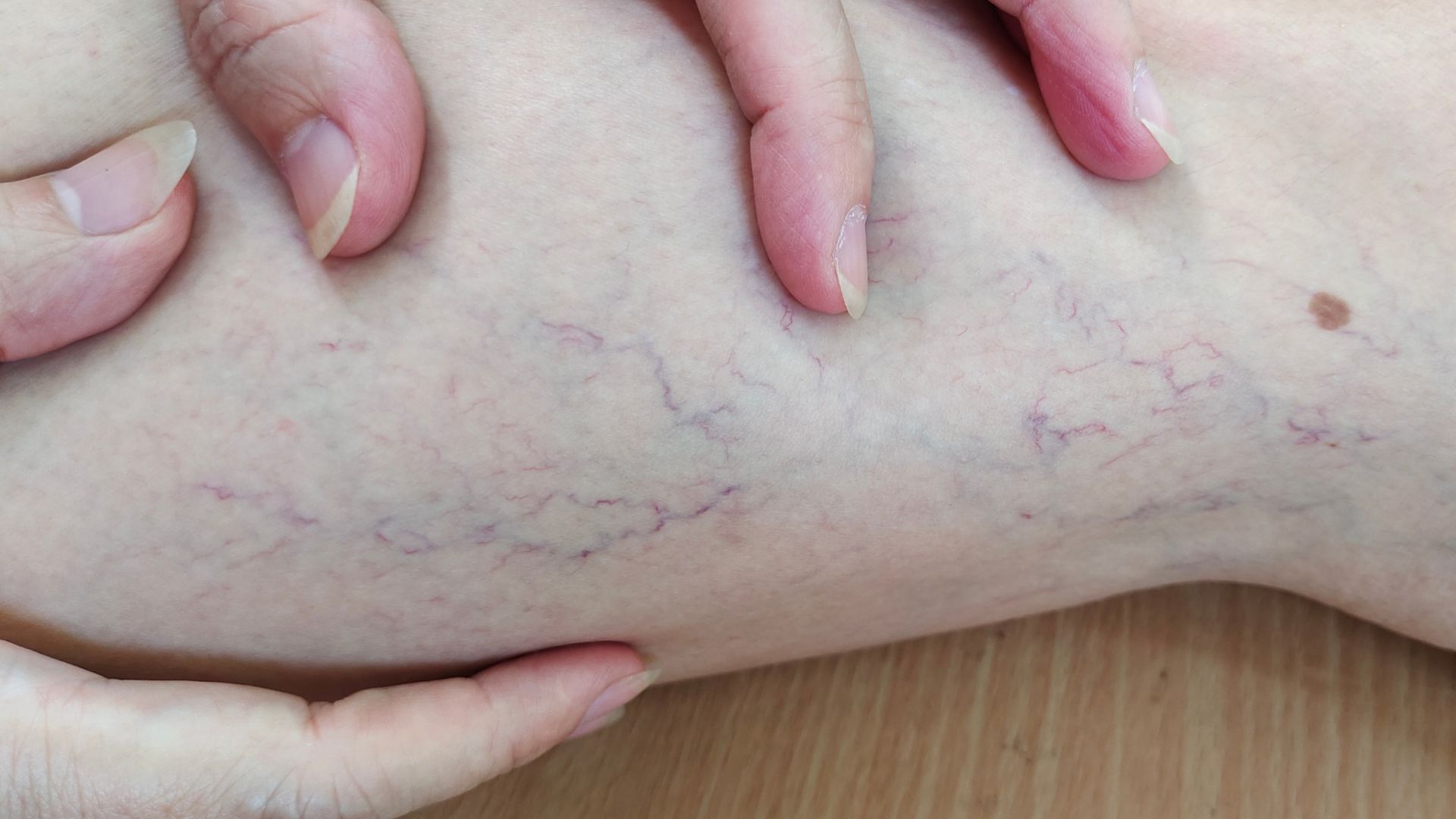 Suy giãn tĩnh mạch là một trong những bệnh lý về tĩnh mạch thường gặp