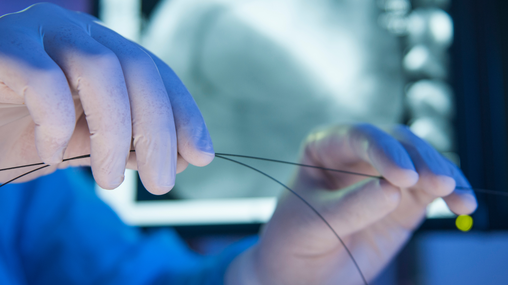 Đặt stent nội mạch giúp tái thông dòng máu trong tĩnh mạch chủ trên hiệu quả