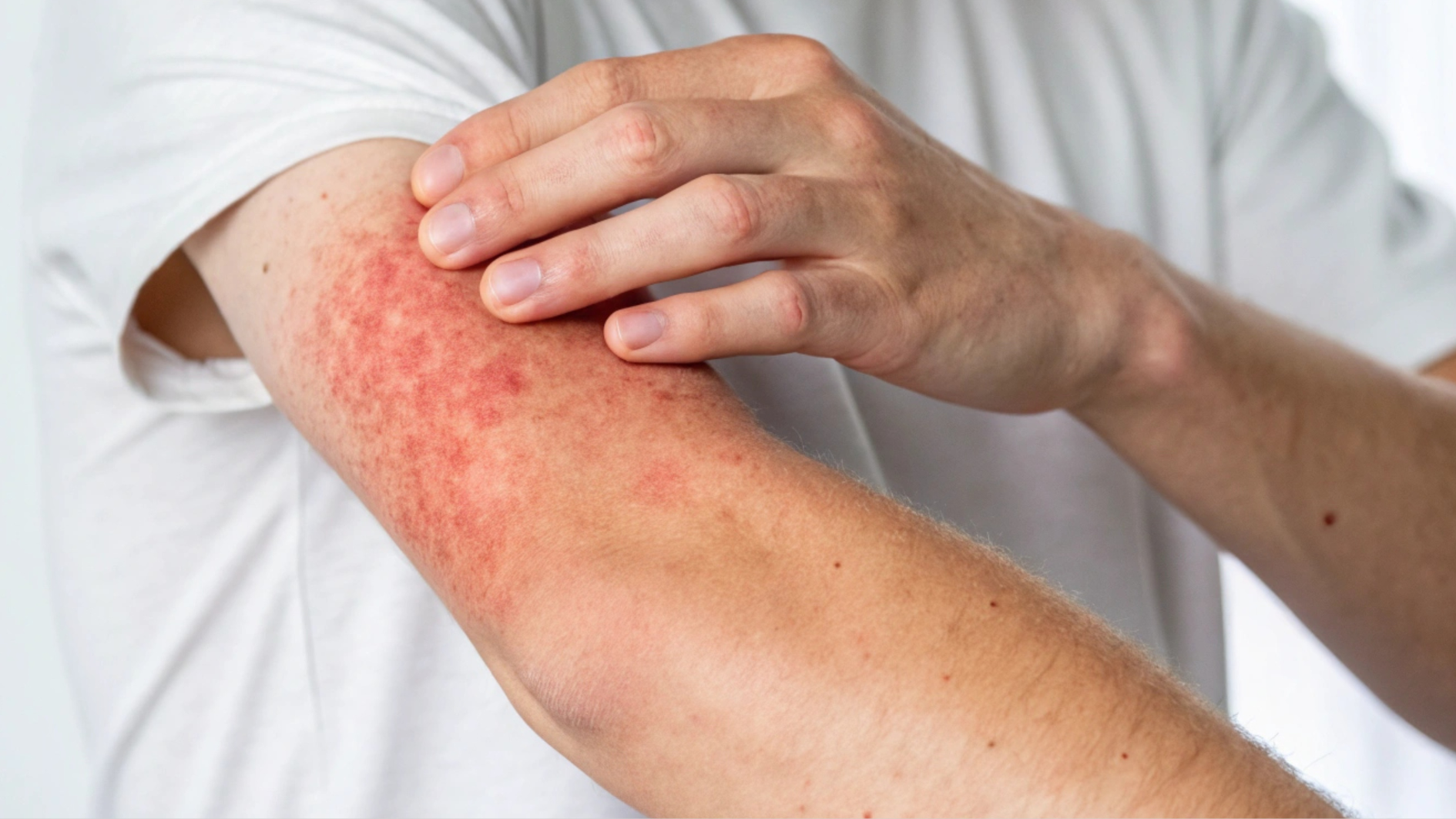 Ban xuất huyết dưới da là những chấm nhỏ, tròn có màu đỏ