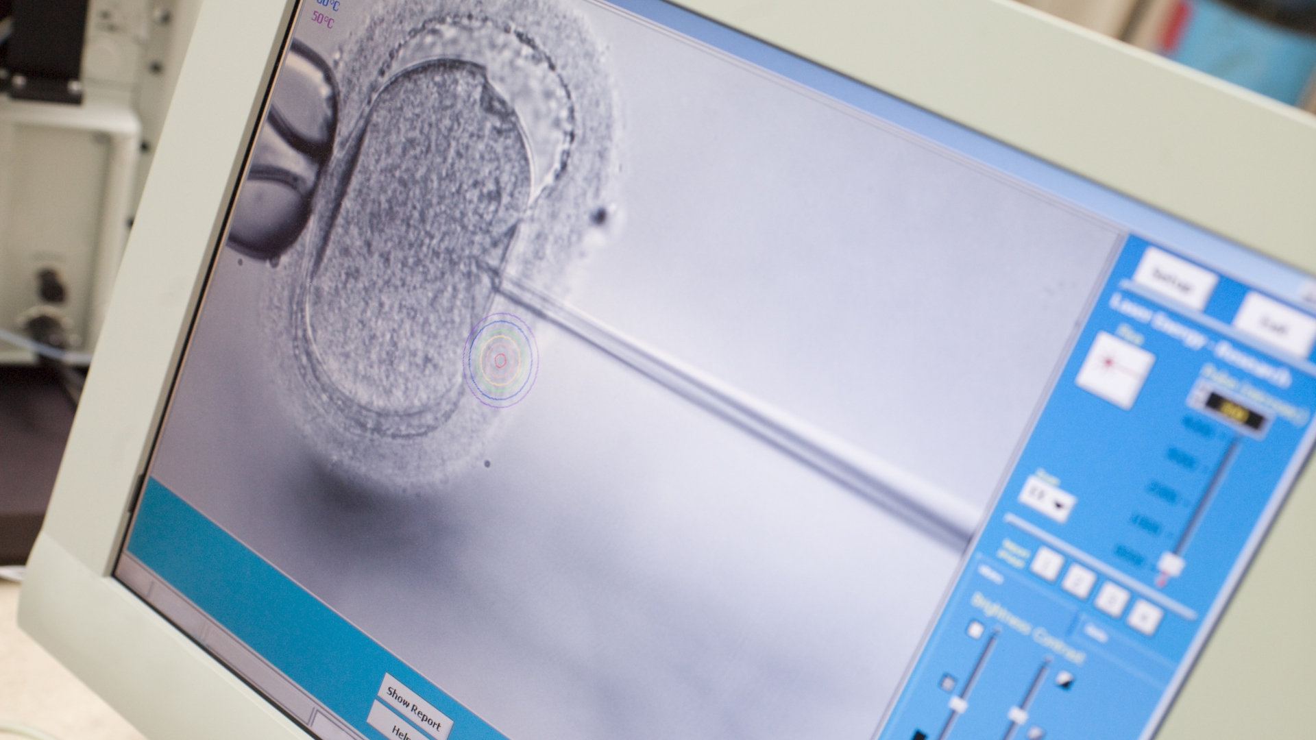 Phương pháp ICSI sẽ được lựa chọn khi tinh trùng dị dạng nhiều hoặc khả năng di chuyển kém