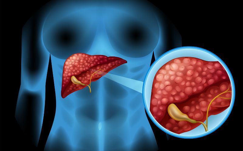 Viêm gan B ở trẻ nhỏ có nguy cơ cao sẽ trở thành viêm gan mạn tính