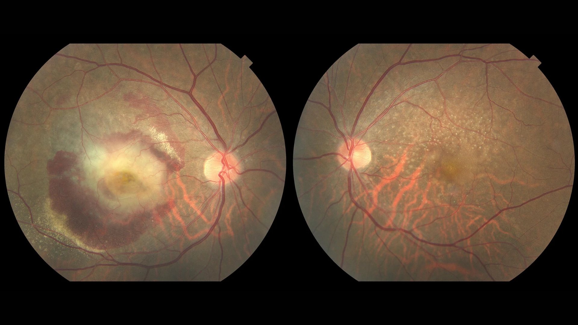 Thoái hóa điểm vàng là bệnh lý ảnh hưởng đến vùng trung tâm võng mạc