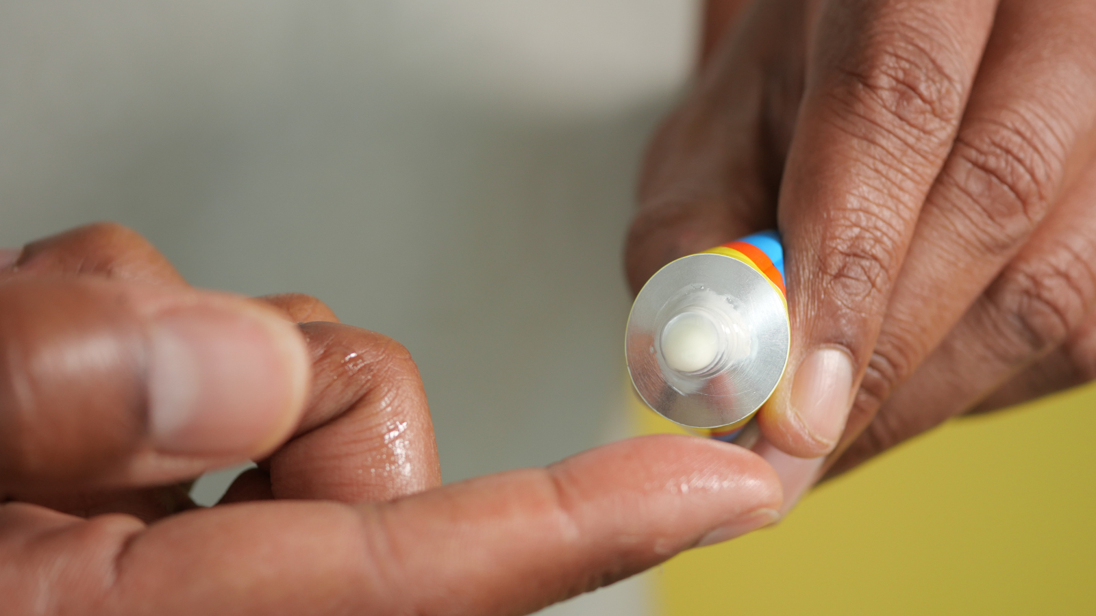 Thuốc bôi thủy đậu giúp bảo vệ tổn thương da và hạn chế biến chứng