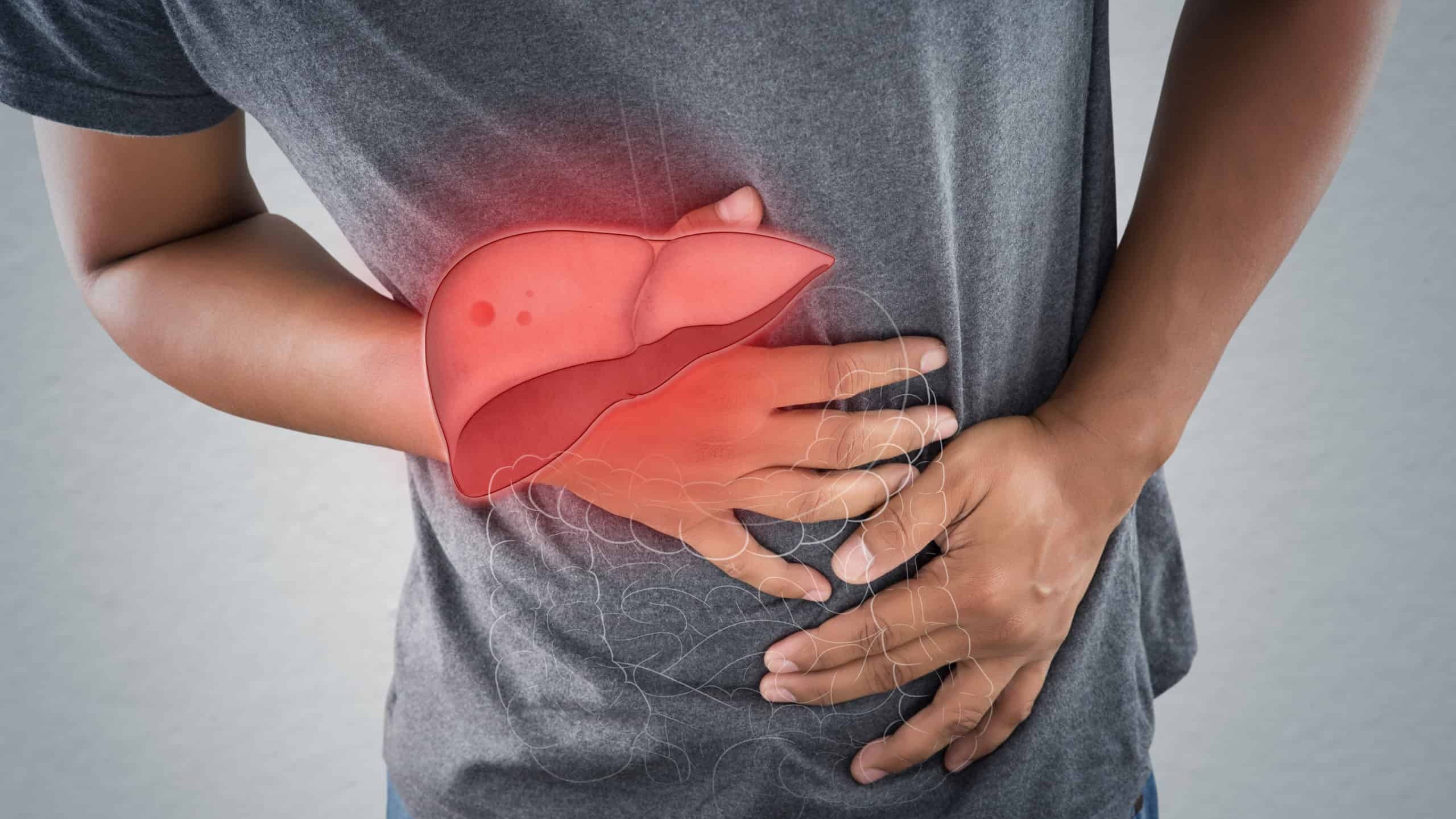 Nhóm người mắc xơ gan có nguy cơ cao nhất bị tràn dịch màng bụng