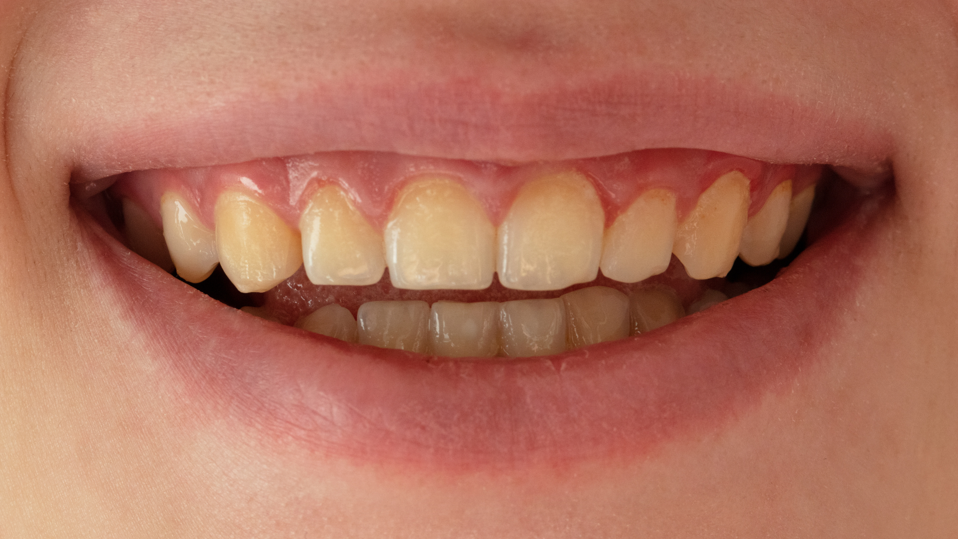 Tráng men răng giúp cải thiện màu sắc, điều chỉnh hình dáng răng, mang lại nụ cười đều đẹp tự nhiên