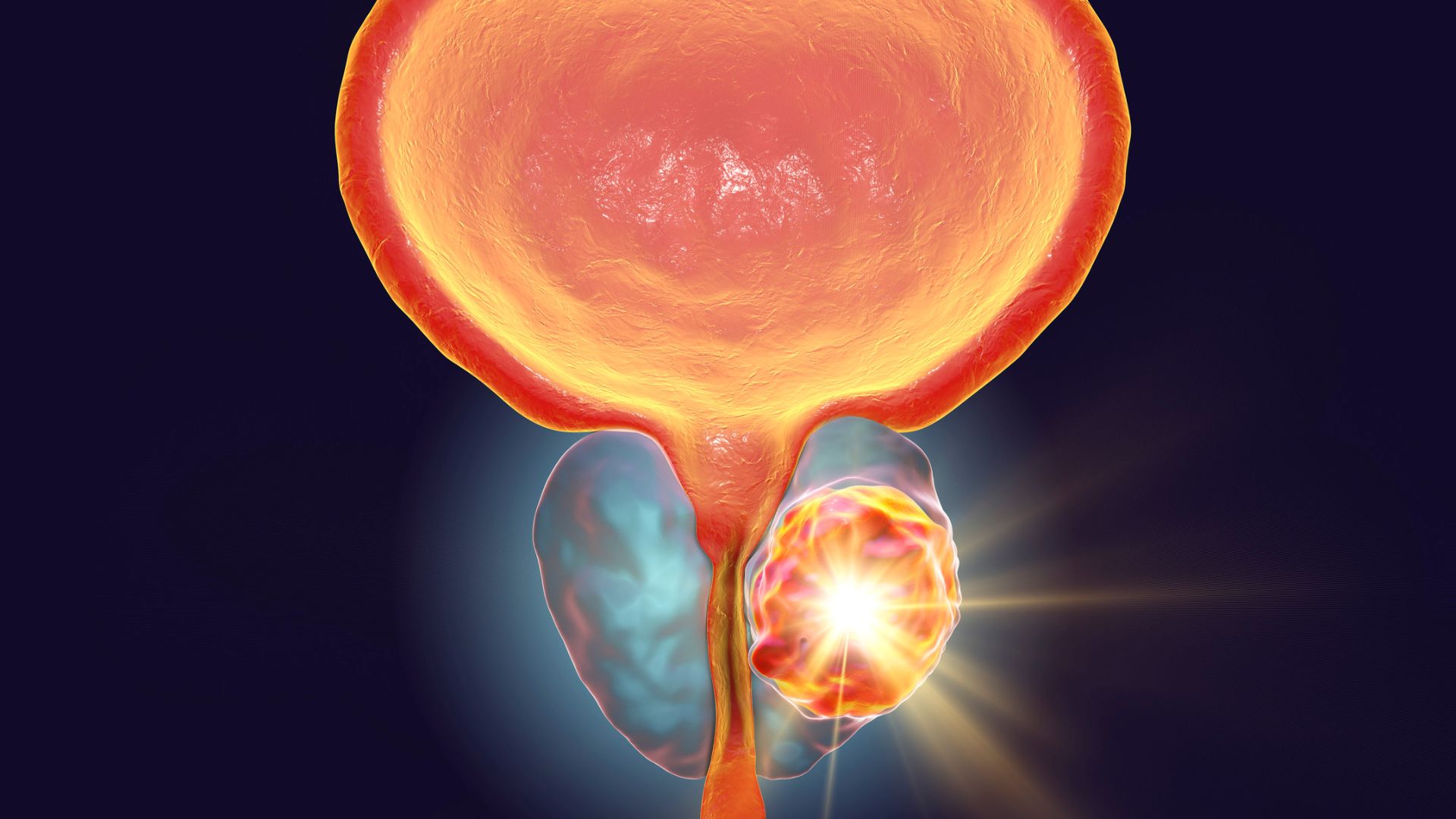 Khối u tiền liệt tuyến chèn ép niệu đạo có thể gây trào ngược bàng quang niệu quản