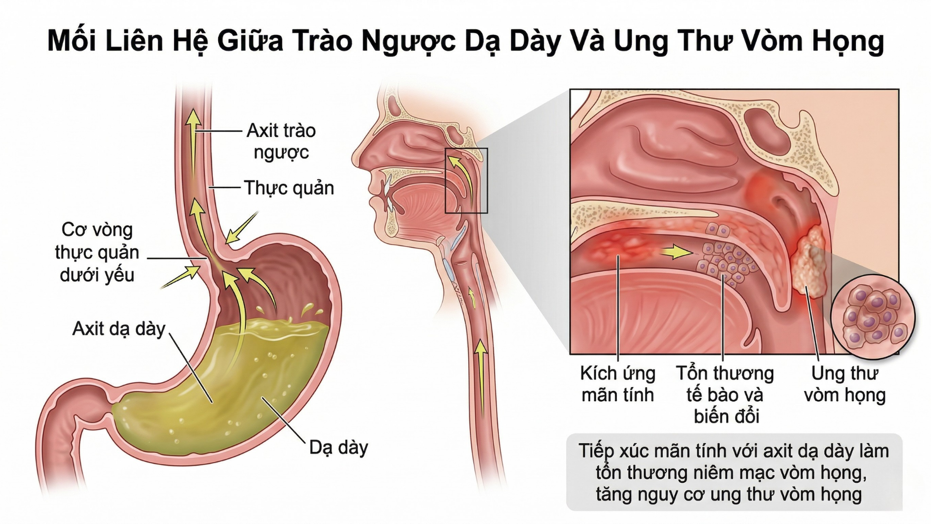 Trào ngược dạ dày gây ung thư vòm họng có đúng không?