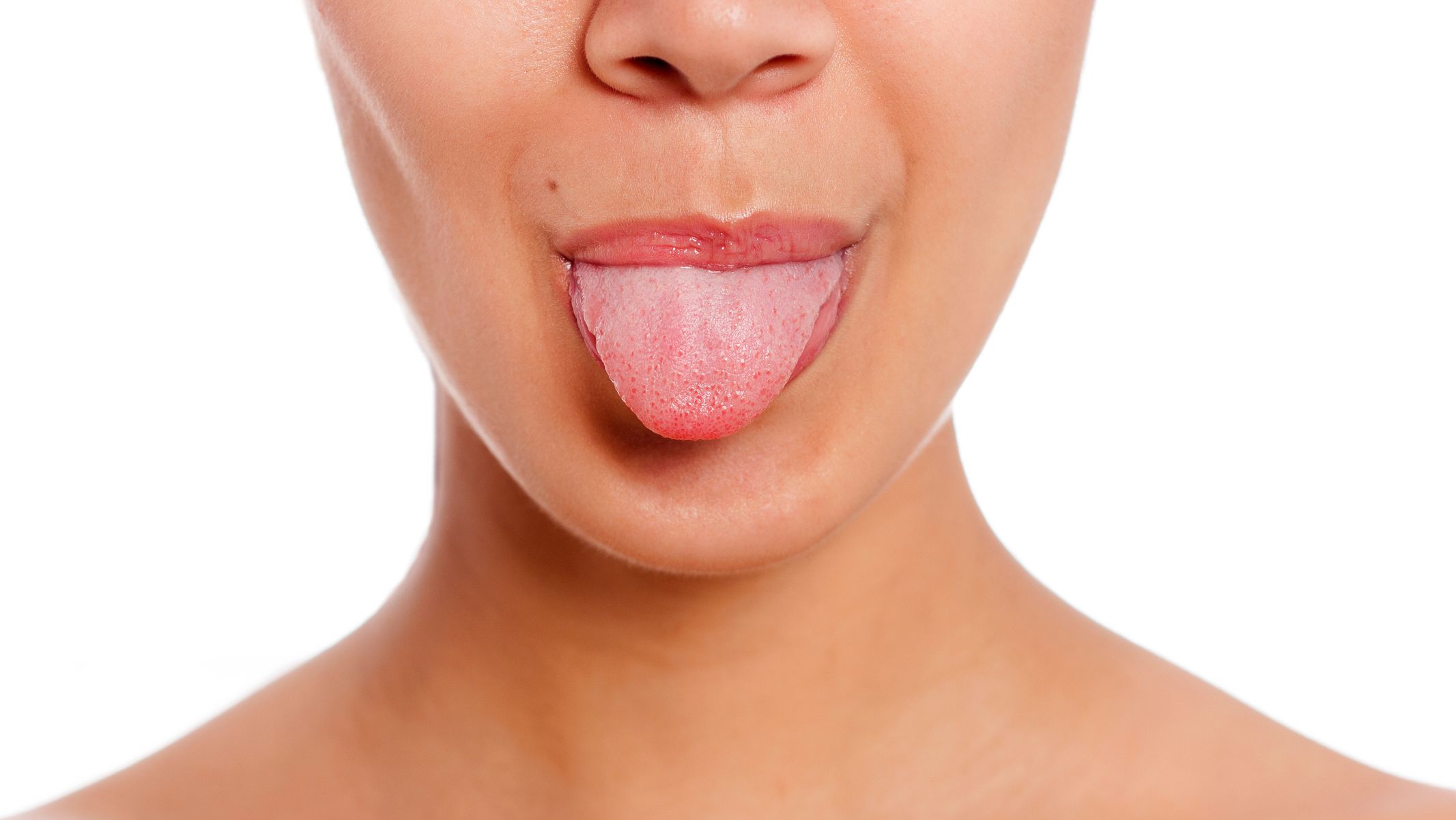 Trào ngược dạ dày lưỡi trắng là gì? Nguyên nhân và dấu hiệu nhận biết 3