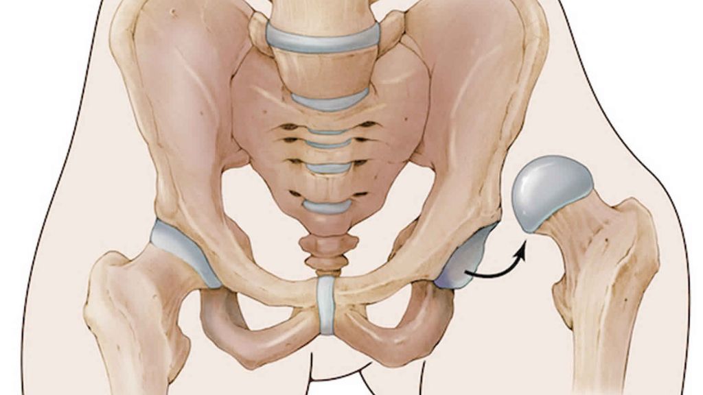 Trật khớp háng đôi khi không biểu hiện rõ ràng