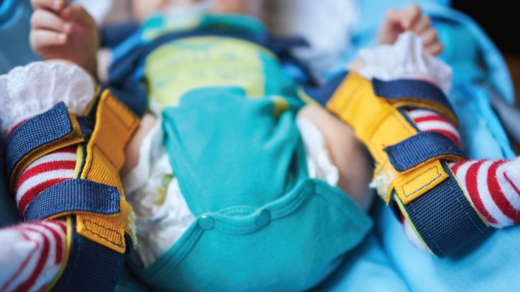 Với trẻ dưới 6 tháng tuổi, phương pháp ưu tiên là sử dụng đai Pavlik