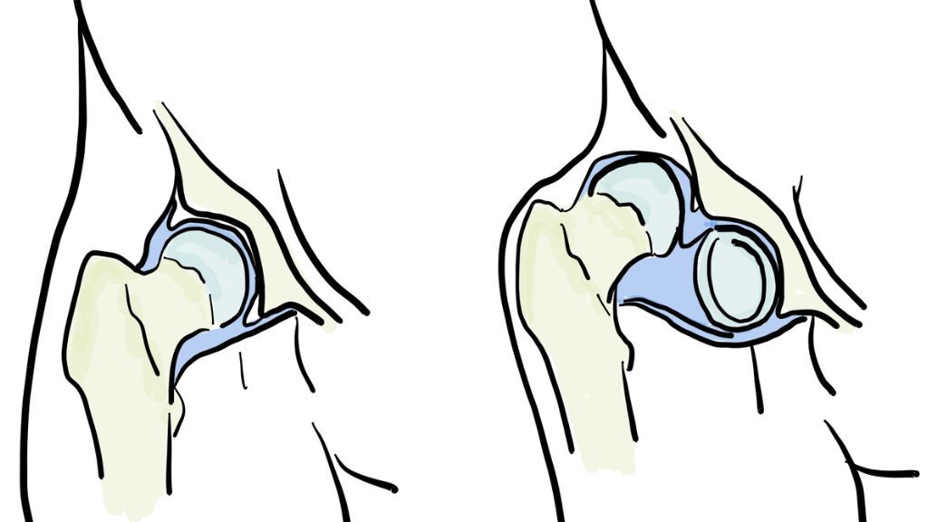 Ước tính khoảng 80 – 95% trẻ được chẩn đoán sớm có kết quả điều trị thành công