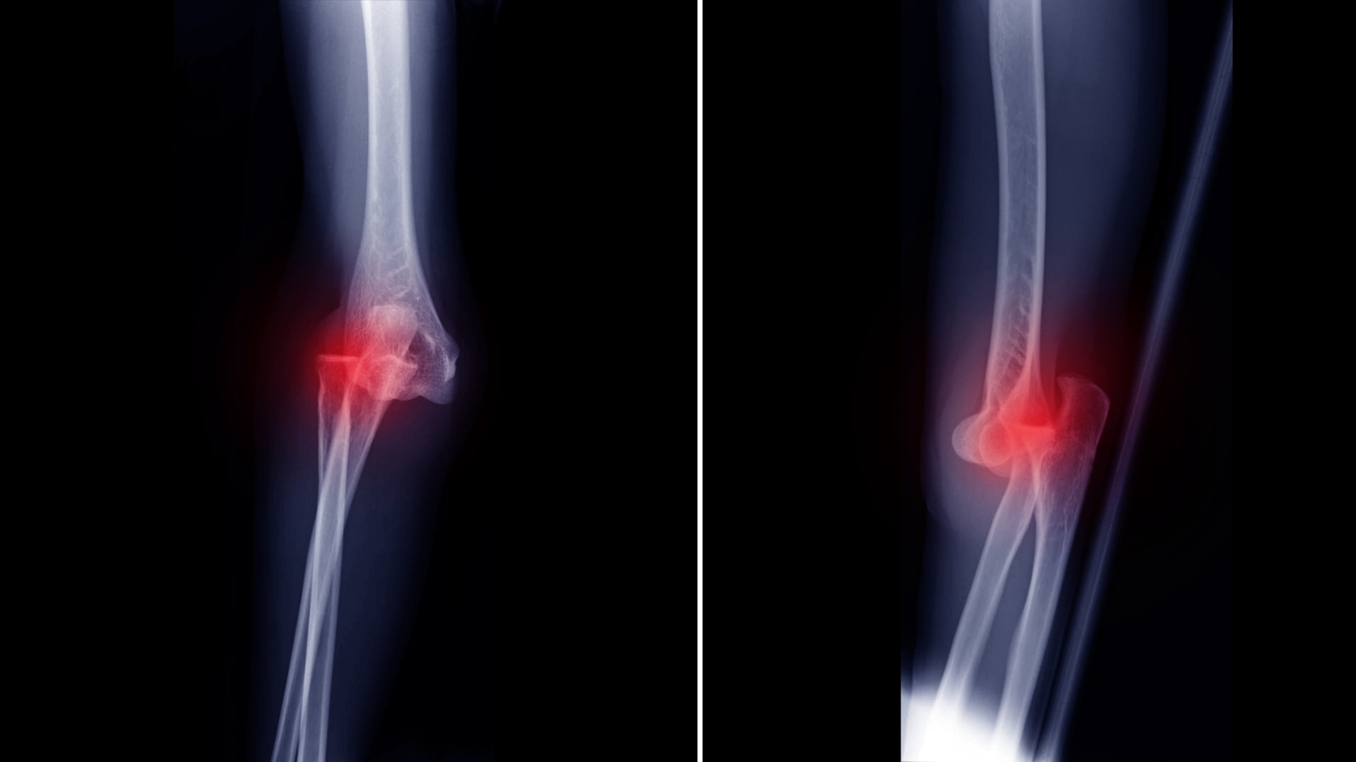 Chụp X-quang là phương tiện chẩn đoán cơ bản và phổ biến nhất