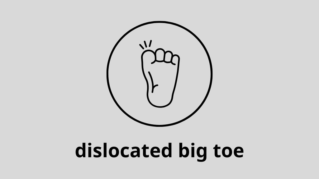 Đa phần các trường hợp trật khớp ngón chân cái có thể được nắn chỉnh và phục hồi tốt nếu được xử lý kịp thời