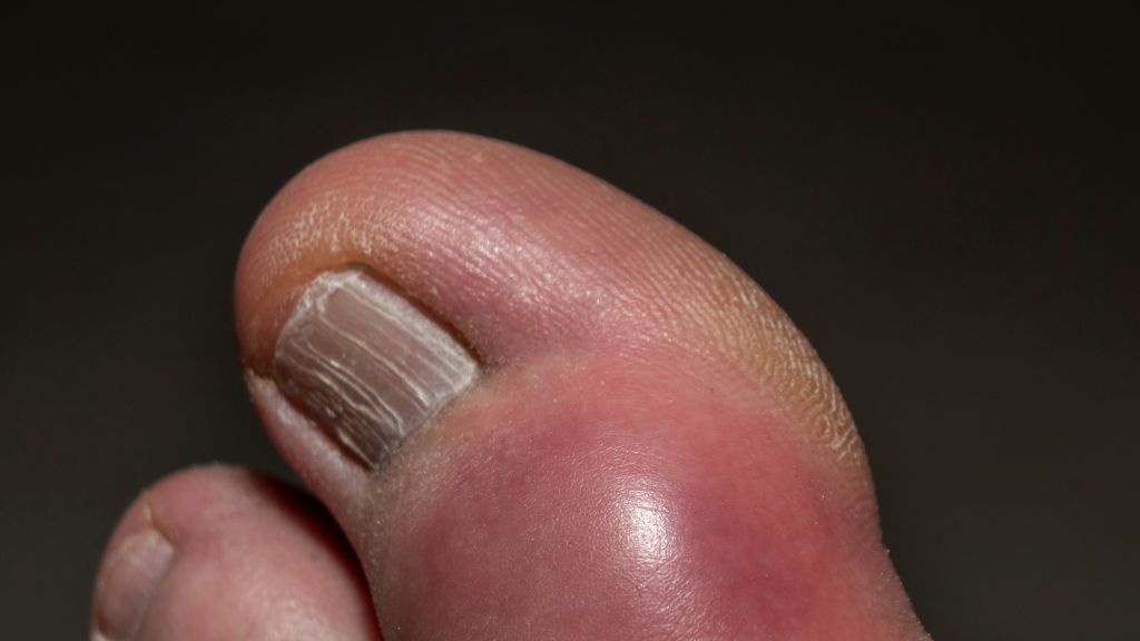 Biểu hiện của trật khớp dễ bị nhầm với bong gân ngón chân cái, vì cả hai đều gây sưng đau và hạn chế vận động