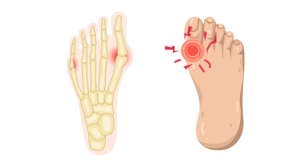 Nếu trật khớp không được nắn đúng cách và cố định đủ lâu, khớp sẽ dễ bị lỏng lẻo, tăng nguy cơ tái trật