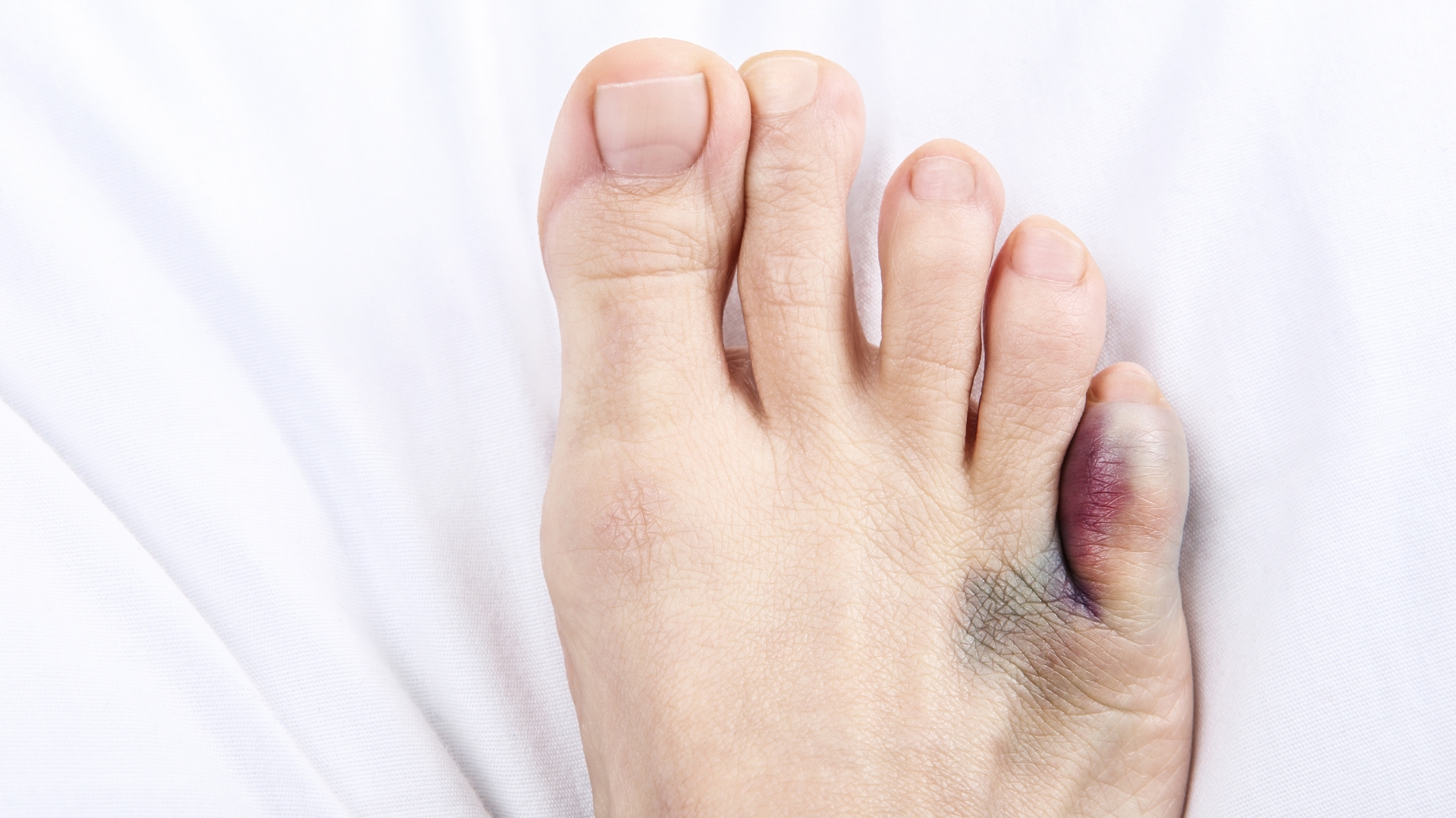 Khu vực quanh khớp bị trật thường sưng to, có thể kèm theo vết bầm do tụ máu dưới da